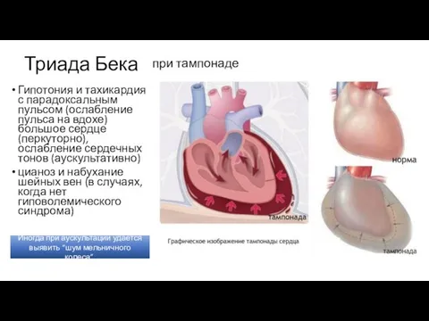 Триада Бека Гипотония и тахикардия с парадоксальным пульсом (ослабление пульса на