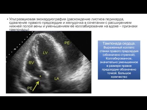 Ультразвуковая эхокардиография (расхождение листков перикарда, сдавление правого предсердия и желудочка в
