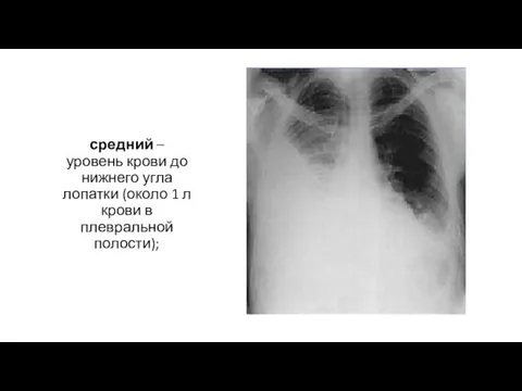 средний – уровень крови до нижнего угла лопатки (около 1 л крови в плевральной полости);