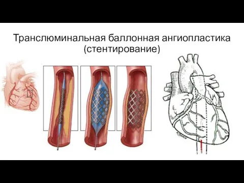 Транслюминальная баллонная ангиопластика (стентирование)