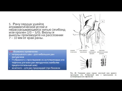 5. Рану сердца ушейте атравматической иглой и нерассасывающейся нитью (этибонд или