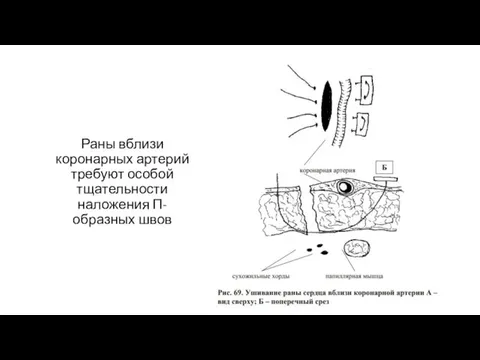 Раны вблизи коронарных артерий требуют особой тщательности наложения П-образных швов