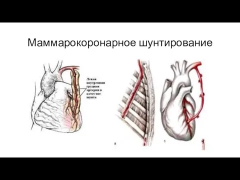 Маммарокоронарное шунтирование