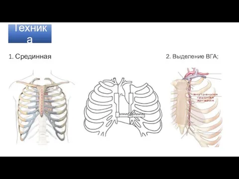 Техника 1. Срединная стернотомия 2. Выделение ВГА;