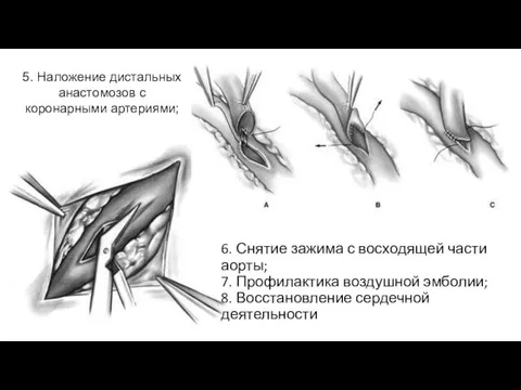 5. Наложение дистальных анастомозов с коронарными артериями; 6. Снятие зажима с