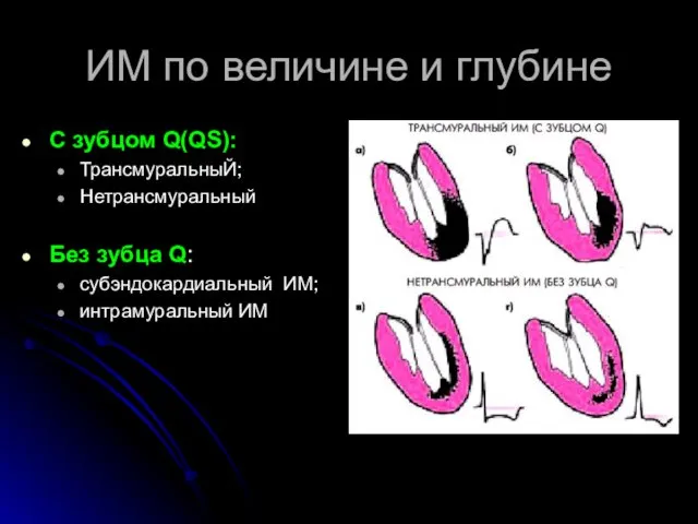 ИМ по величине и глубине С зубцом Q(QS): ТрансмуральныЙ; Нетрансмуральный Без