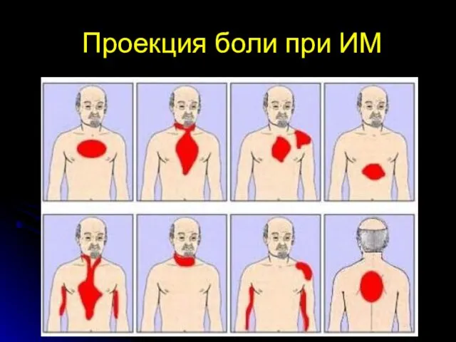 Проекция боли при ИМ