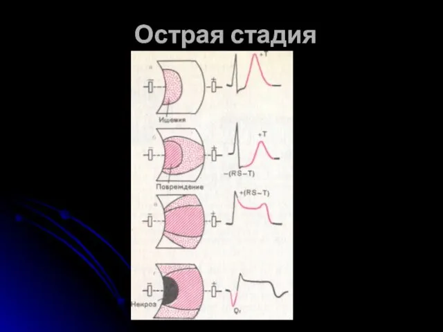 Острая стадия