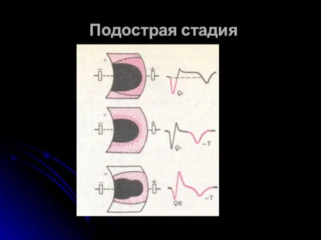 Подострая стадия