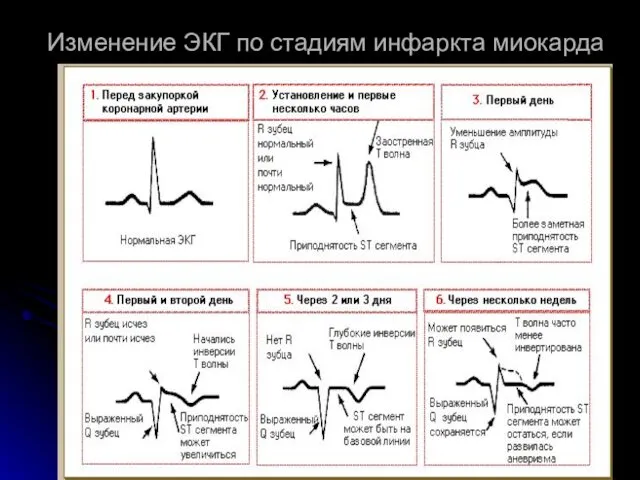 Изменение ЭКГ по стадиям инфаркта миокарда