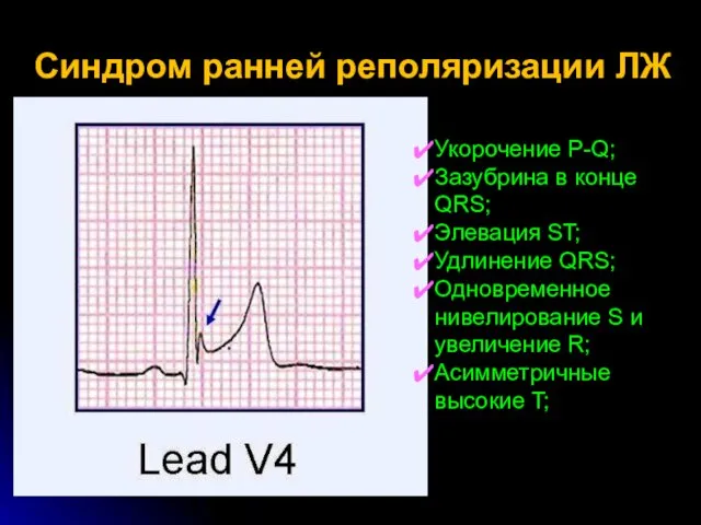 Синдром ранней реполяризации ЛЖ Укорочение P-Q; Зазубрина в конце QRS; Элевация