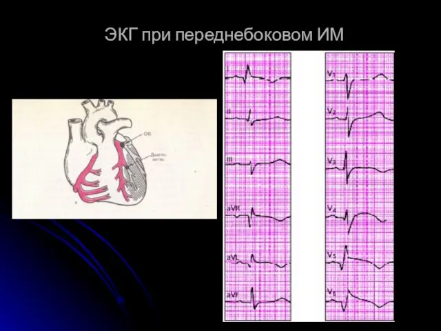 ЭКГ при переднебоковом ИМ