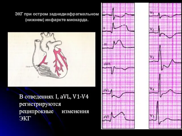 ЭКГ при остром заднедиафрагмальном (нижнем) инфаркте миокарда. В отведениях I, aVL, V1-V4 регистрируются реципрокные изменения ЭКГ