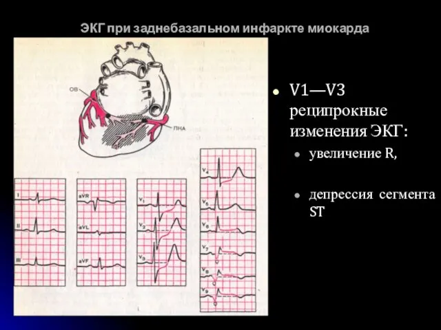 ЭКГ при заднебазальном инфаркте миокарда V1—V3 реципрокные изменения ЭКГ: увеличение R, депрессия сегмента ST