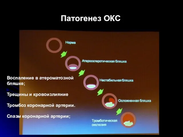 Воспаление в атероматозной бляшке; Трещины и кровоизлияние Тромбоз коронарной артерии. Спазм коронарной артерии; Патогенез ОКС