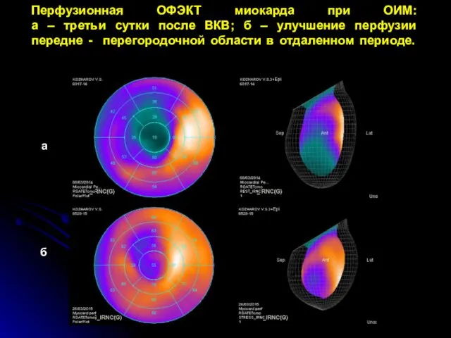 Перфузионная ОФЭКТ миокарда при ОИМ: а – третьи сутки после ВКВ;