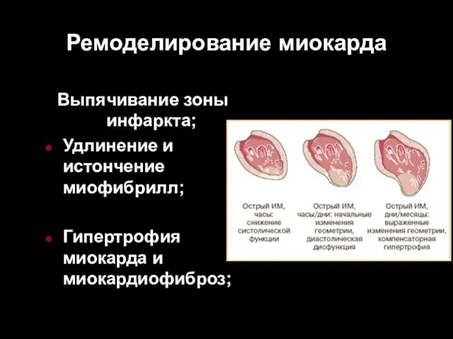 Ремоделирование миокарда Выпячивание зоны инфаркта; Удлинение и истончение миофибрилл; Гипертрофия миокарда и миокардиофиброз;