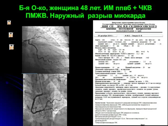 Б-я О-ко, женщина 48 лет. ИМ ппвб + ЧКВ ПМЖВ. Наружный разрыв миокарда