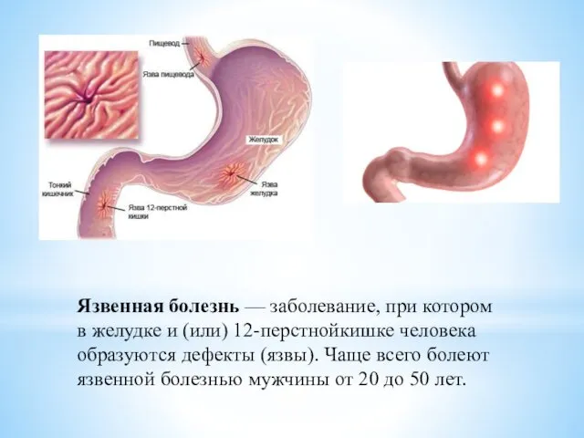 Язвенная болезнь — заболевание, при котором в желудке и (или) 12-перстнойкишке