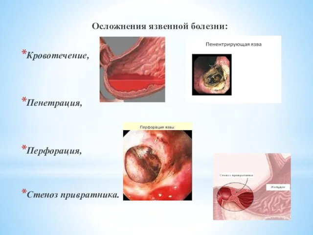 Осложнения язвенной болезни: Кровотечение, Пенетрация, Перфорация, Стеноз привратника.