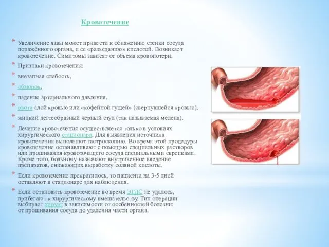 Кровотечение Увеличение язвы может привести к обнажению стенки сосуда поражённого органа,