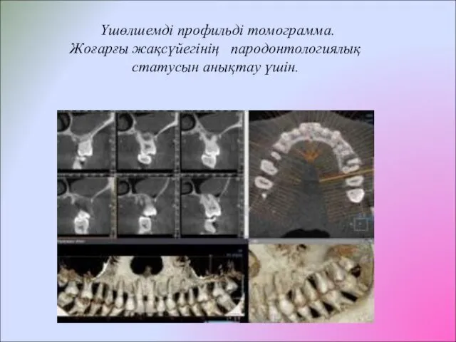 Үшөлшемді профильді томограмма. Жоғарғы жақсүйегінің пародонтологиялық статусын анықтау үшін.