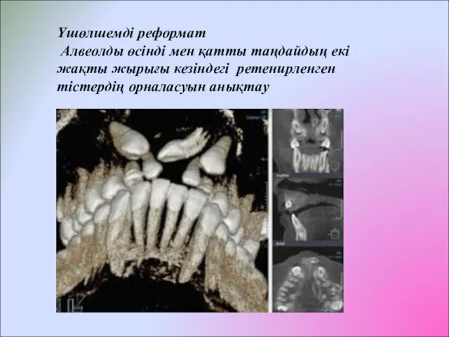 Үшөлшемді реформат Алвеолды өсінді мен қатты таңдайдың екі жақты жырығы кезіндегі ретенирленген тістердің орналасуын анықтау