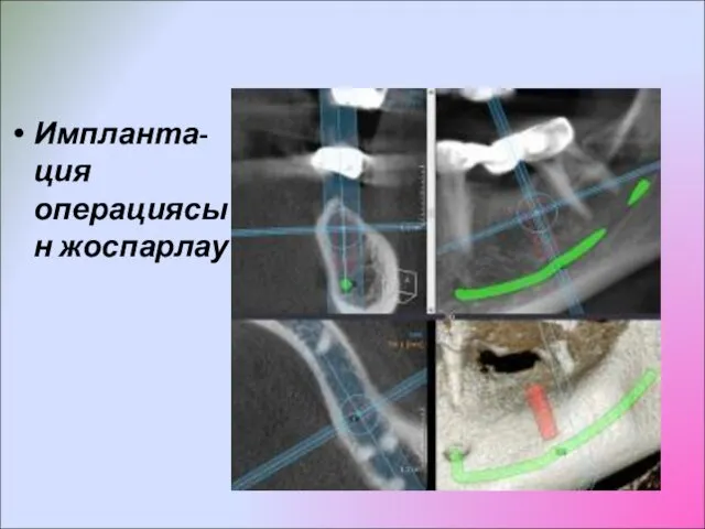 Импланта-ция операциясын жоспарлау