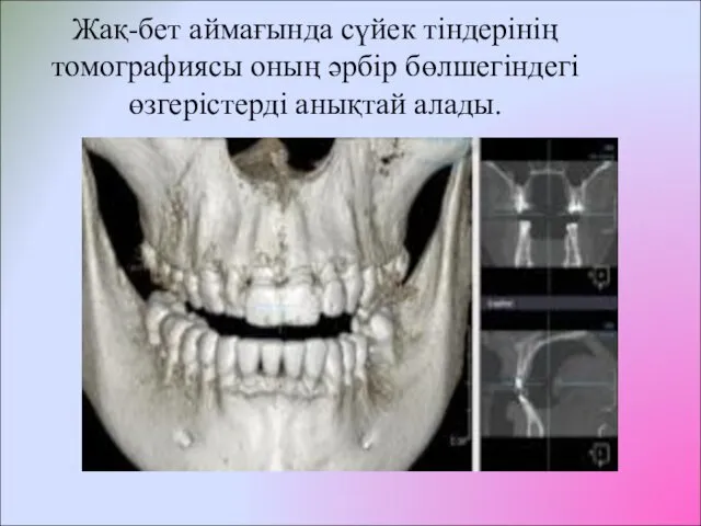 Жақ-бет аймағында сүйек тіндерінің томографиясы оның әрбір бөлшегіндегі өзгерістерді анықтай алады.