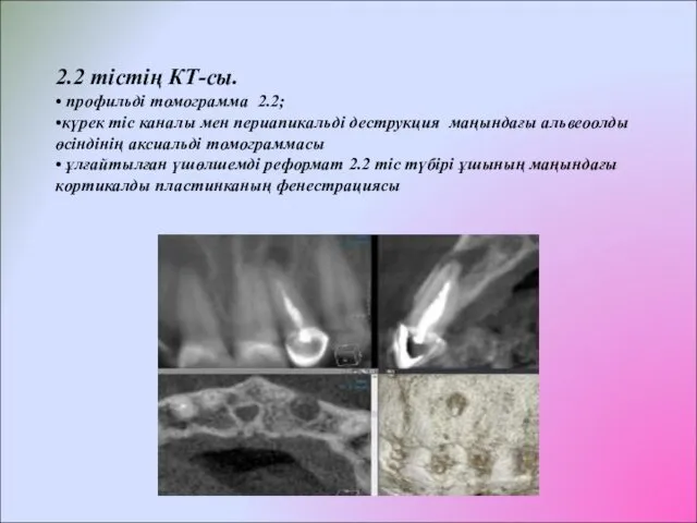 2.2 тістің КТ-сы. • профильді томограмма 2.2; •күрек тіс каналы мен