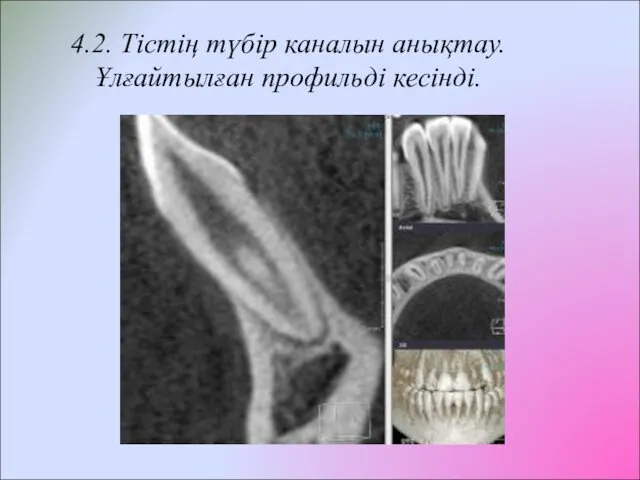 4.2. Тістің түбір каналын анықтау. Ұлғайтылған профильді кесінді.