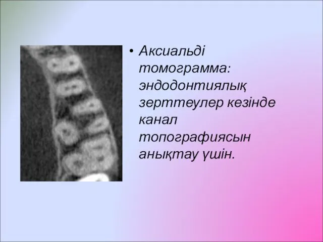 Аксиальді томограмма: эндодонтиялық зерттеулер кезінде канал топографиясын анықтау үшін.