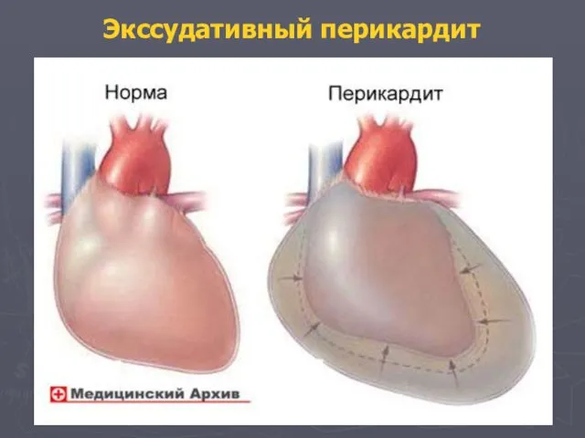 Экссудативный перикардит