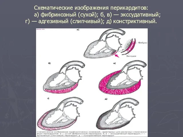 Схематические изображения перикардитов: а) фибринозный (сухой); б, в) — экссудативный; г) — адгезивный (слипчивый); д) констриктивный.