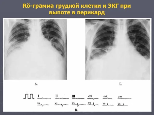 Rö-грамма грудной клетки и ЭКГ при выпоте в перикард