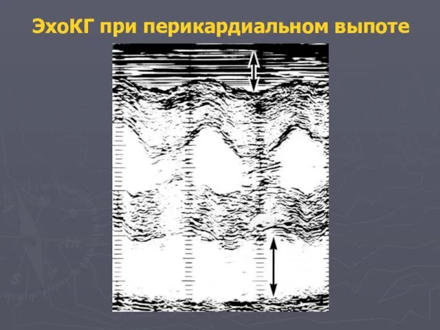 ЭхоКГ при перикардиальном выпоте