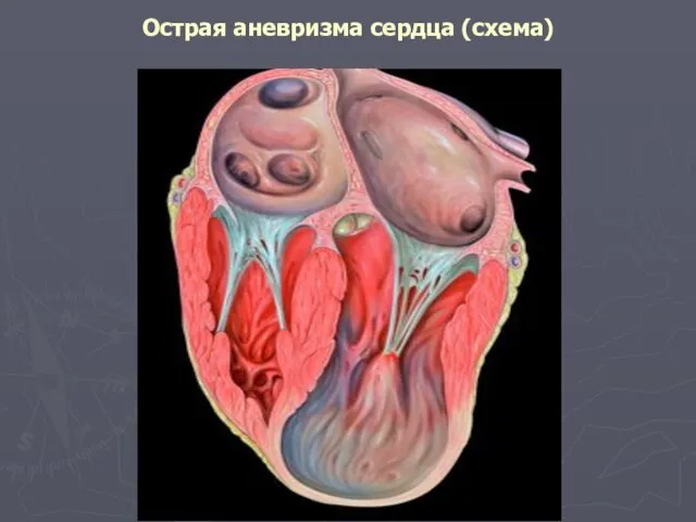Острая аневризма сердца (схема)