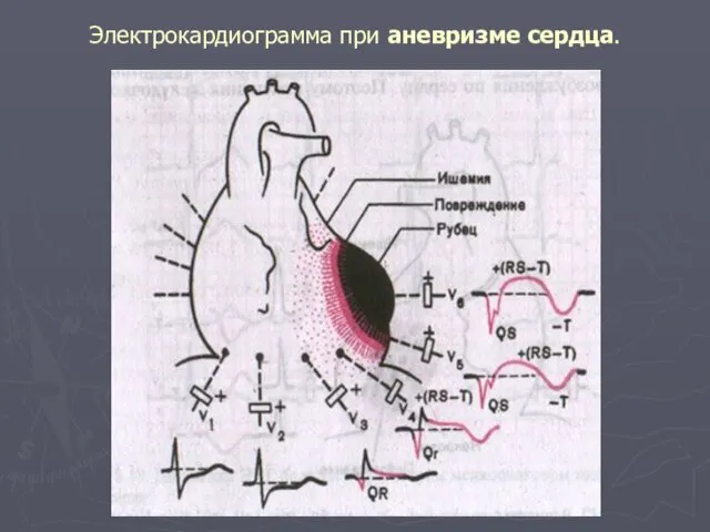 Электрокардиограмма при аневризме сердца.