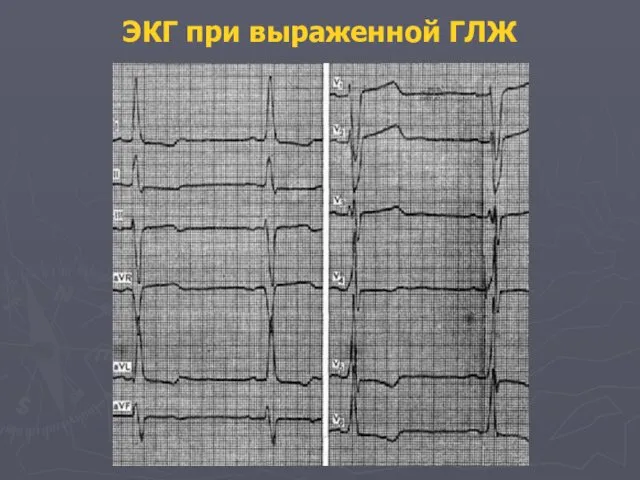 ЭКГ при выраженной ГЛЖ