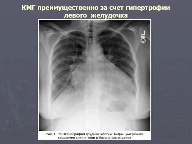 КМГ преимущественно за счет гипертрофии левого желудочка