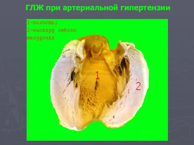 ГЛЖ при артериальной гипертензии