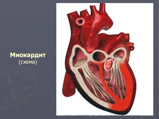 Миокардит (схема)