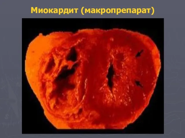 Миокардит (макропрепарат)