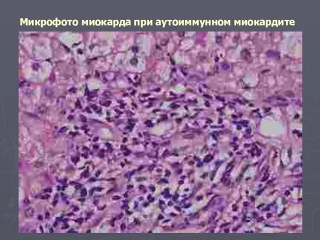 Микрофото миокарда при аутоиммунном миокардите