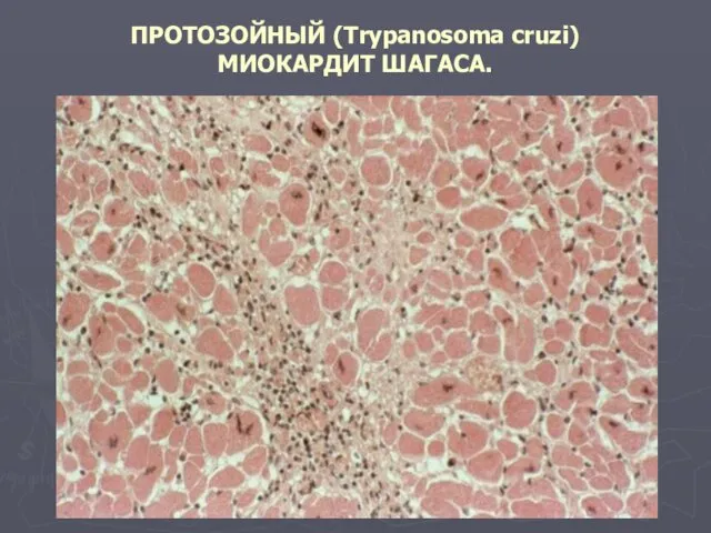 ПРОТОЗОЙНЫЙ (Trypanosoma cruzi) МИОКАРДИТ ШАГАСА.