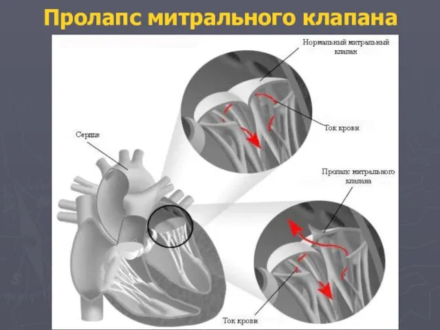 Пролапс митрального клапана