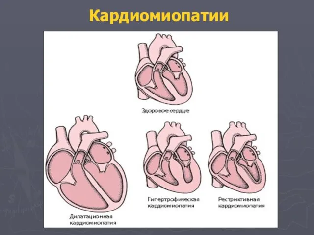 Кардиомиопатии