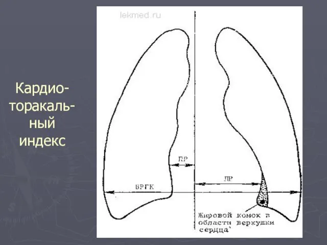 Кардио- торакаль-ный индекс