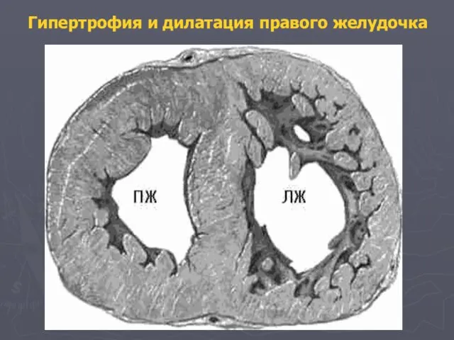 Гипертрофия и дилатация правого желудочка