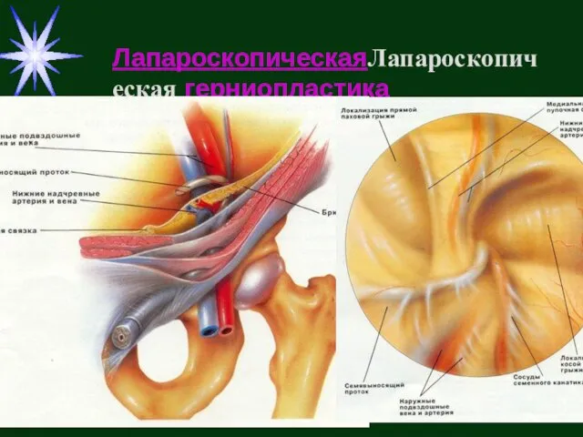 ЛапароскопическаяЛапароскопическая герниопластика